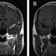 Image for article titled New Study Suggests Alzheimer's Is Associated with Brain Fungus